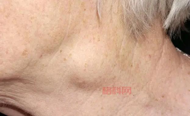 23岁小伙起红疹被误诊6年，最终查出癌症晚期